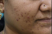 Pigmentation