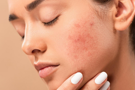 Chemical Peels treatment