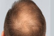 Hair Transplantation